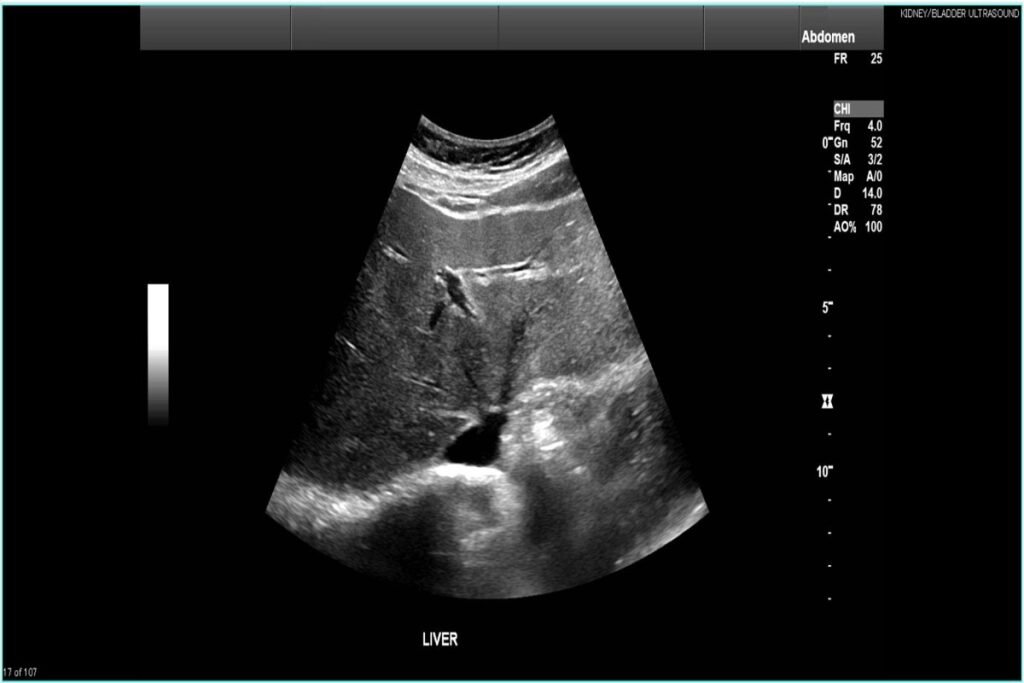 Medical practitioner performing a liver ultrasound scan on a patient's upper right abdomen using a transducer probe.